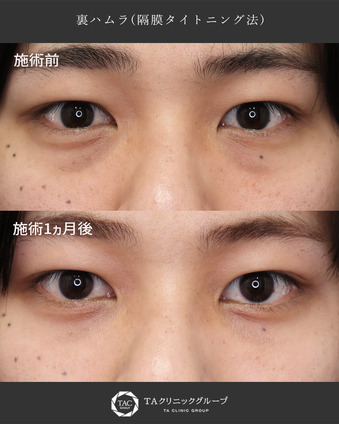 下眼瞼切開術（クマ・たるみとり）の症例写真 施術前後 
