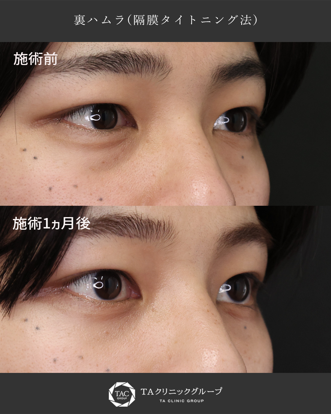 下眼瞼切開術（クマ・たるみとり）の症例写真 施術前後 