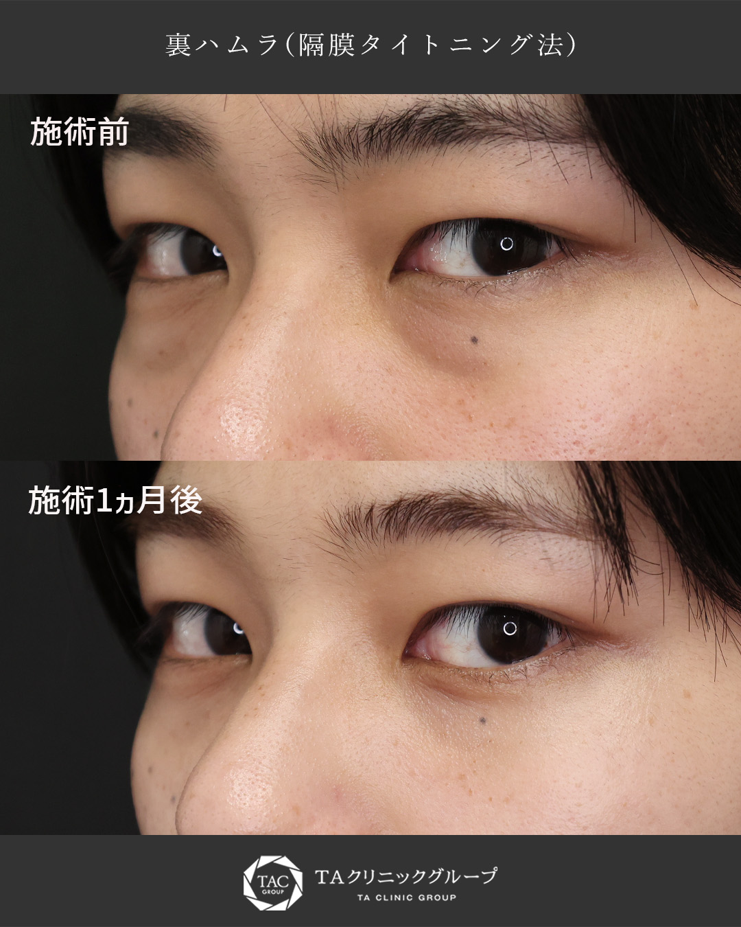 下眼瞼切開術（クマ・たるみとり）の症例写真 施術前後 