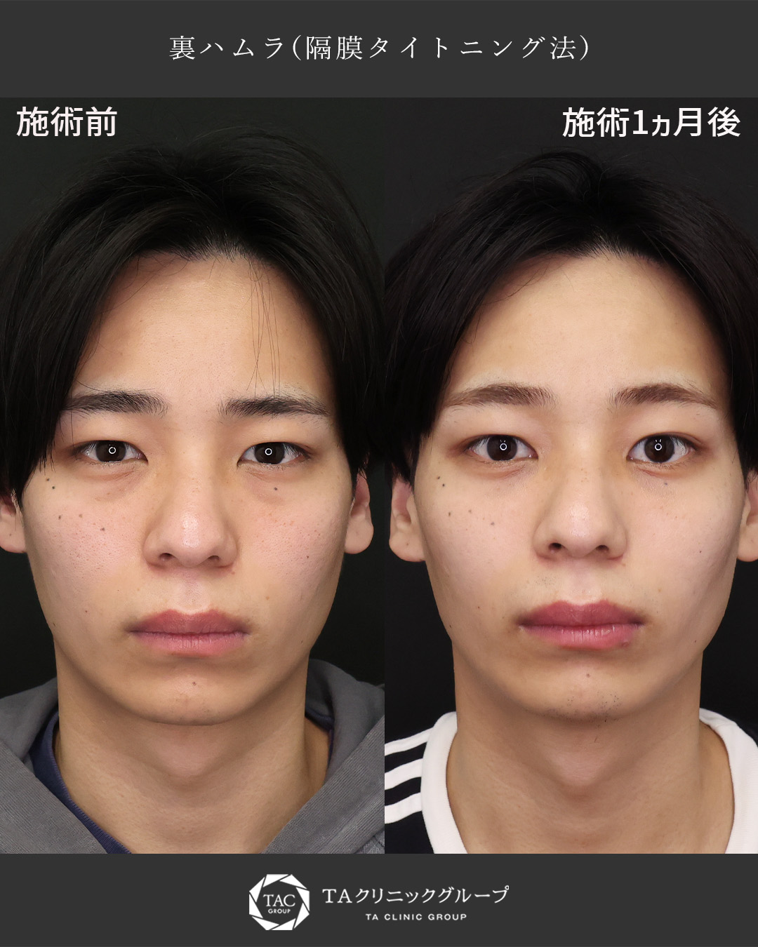 下眼瞼切開術（クマ・たるみとり）の症例写真 施術前後 