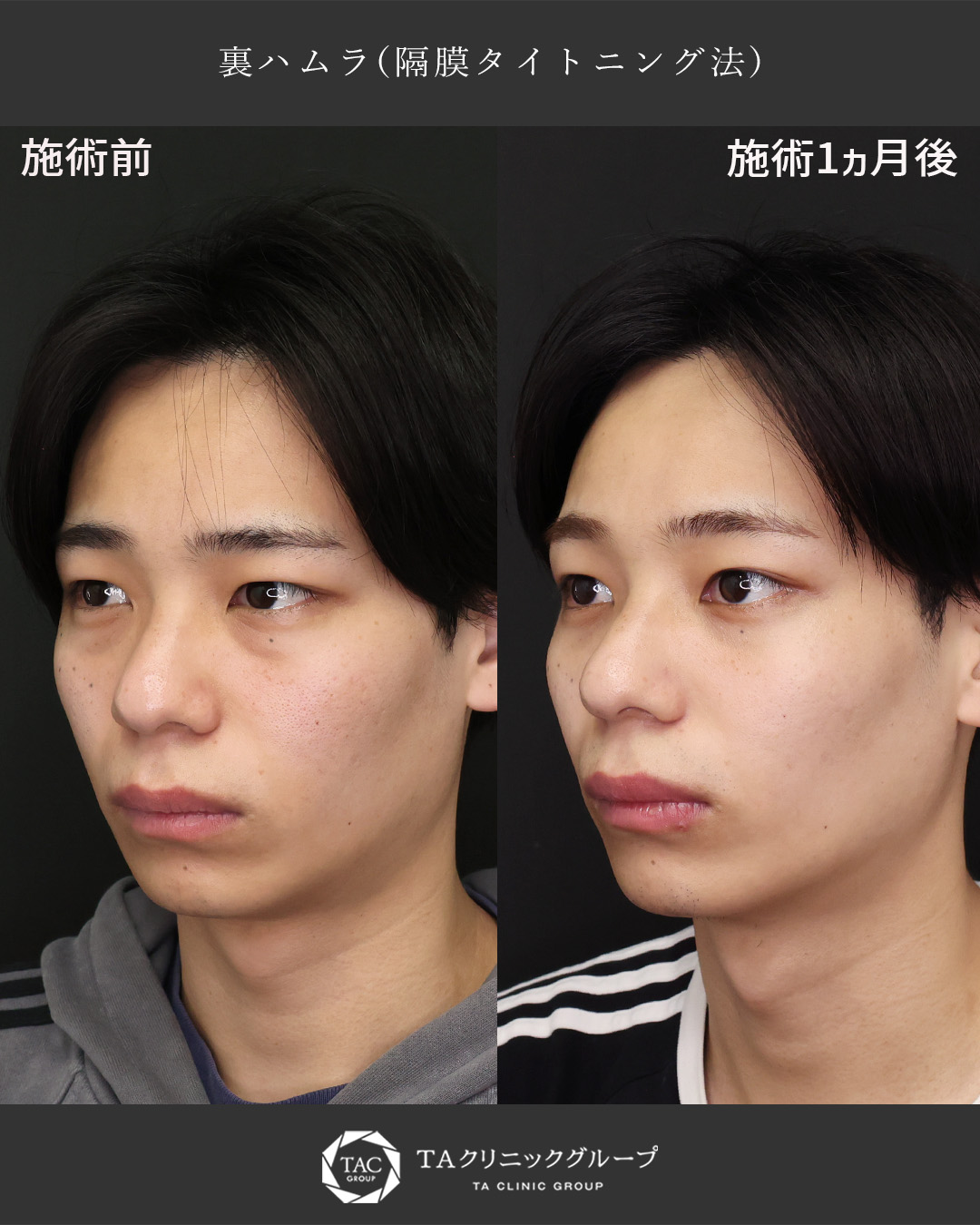 下眼瞼切開術（クマ・たるみとり）の症例写真 施術前後 