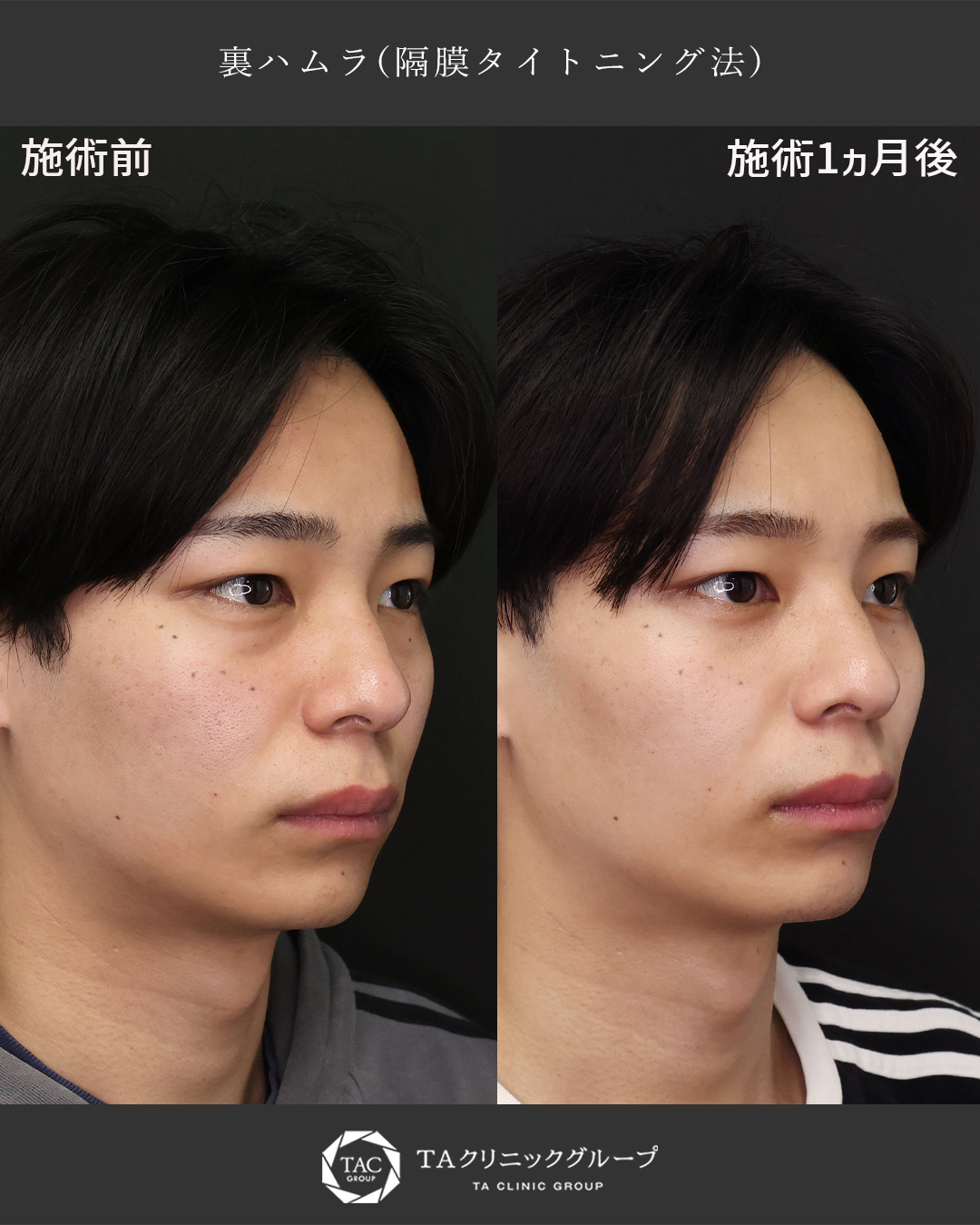 下眼瞼切開術（クマ・たるみとり）の症例写真 施術前後 