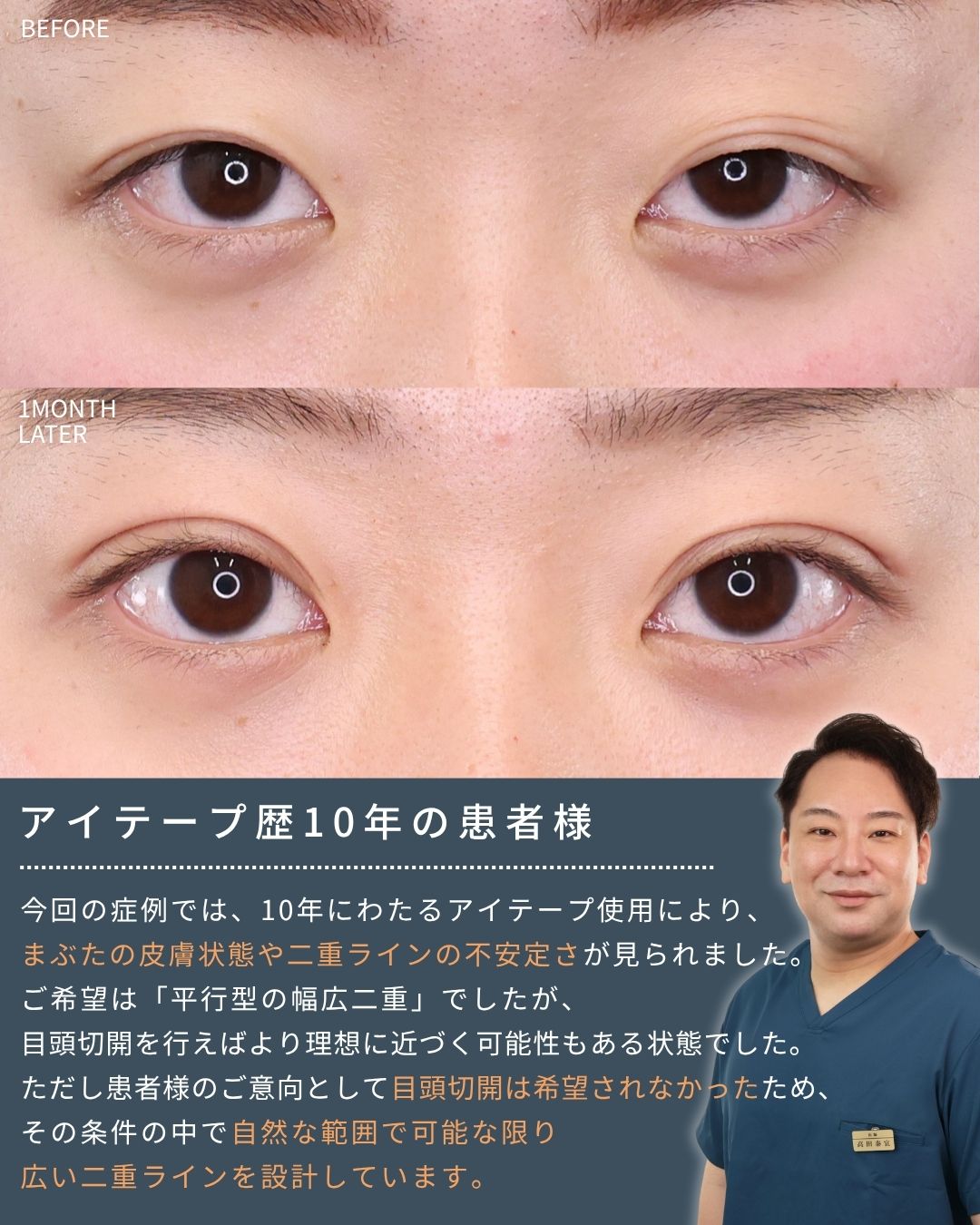 二重埋没法の症例写真 施術前後 