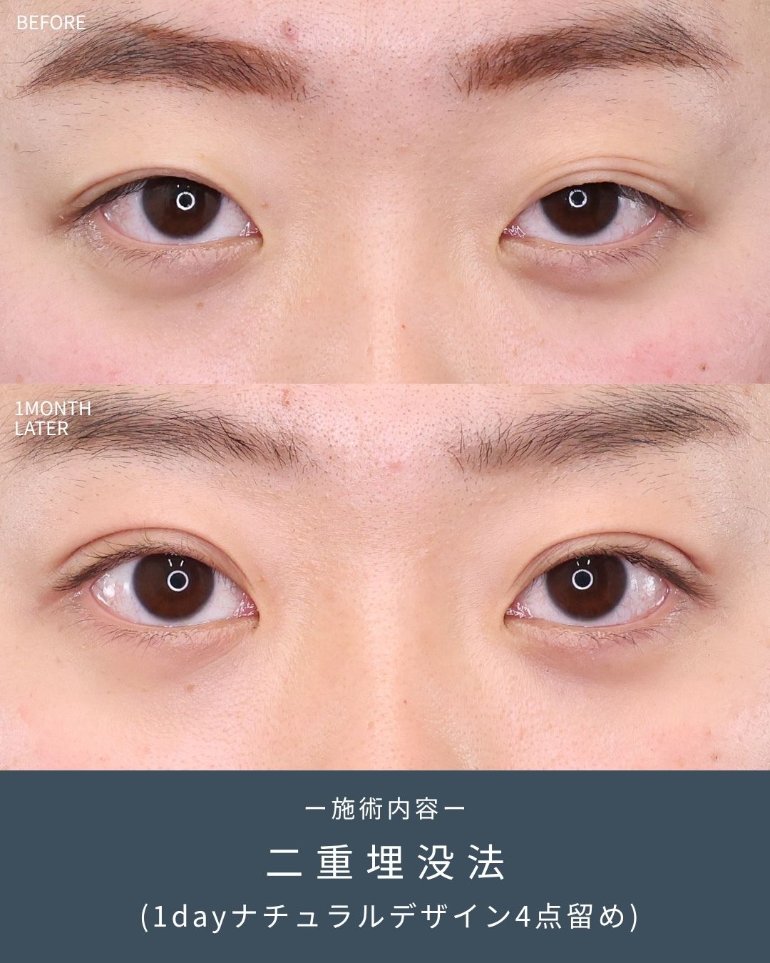 二重埋没法の症例写真 施術前後 