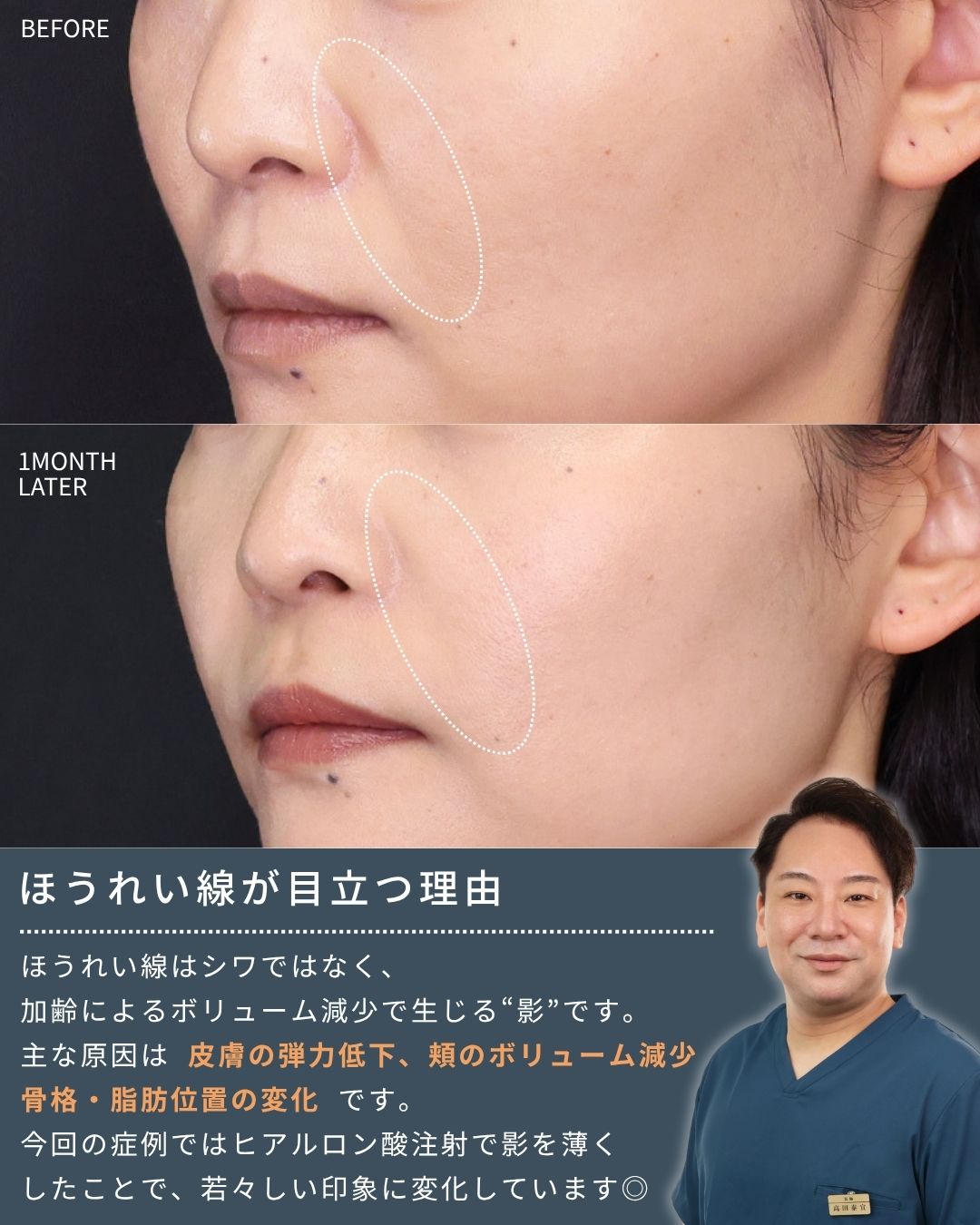 ほうれい線のヒアルロン酸注射の症例写真 施術前後 
