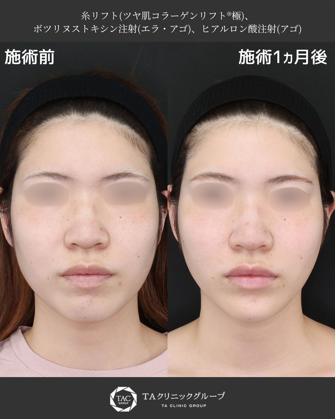 糸リフト×エラボトックスで、エラ張りと食いしばりを自然に改善し小顔へ