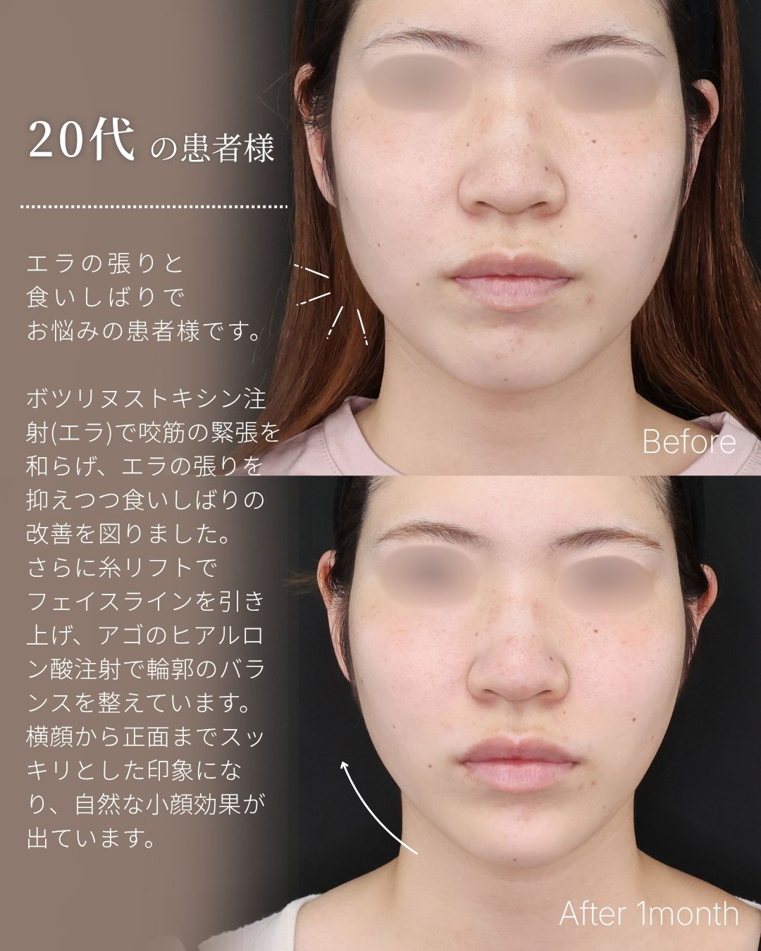 TAC式 ツヤ肌コラーゲンリフト®/顎のヒアルロン酸注射/ボトックス注射：その他の症例写真 施術前後 