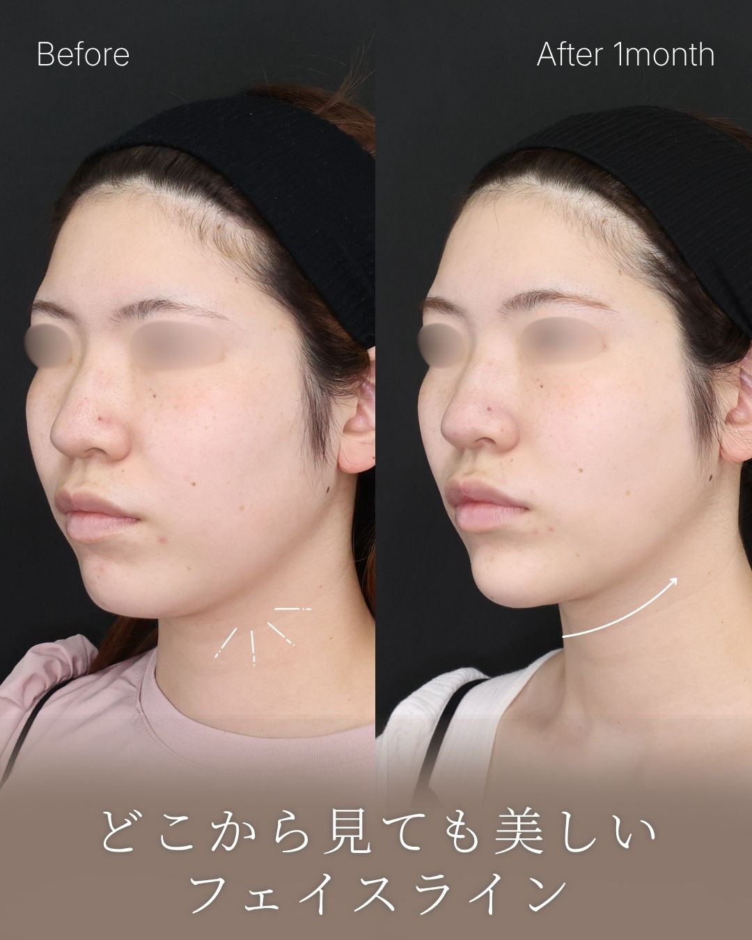 TAC式 ツヤ肌コラーゲンリフト®/顎のヒアルロン酸注射/ボトックス注射：その他の症例写真 施術前後 