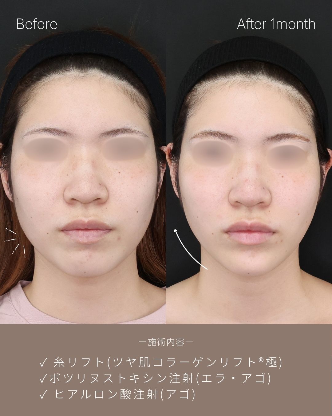 TAC式 ツヤ肌コラーゲンリフト®/顎のヒアルロン酸注射/ボトックス注射：その他の症例写真 施術前後 