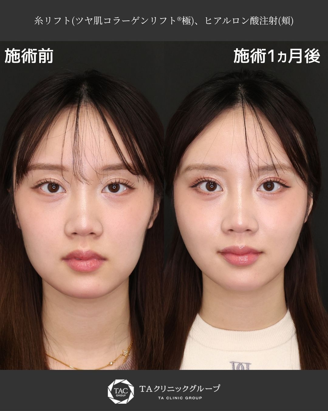 TAC式 ツヤ肌コラーゲンリフト®の症例写真 施術前後 