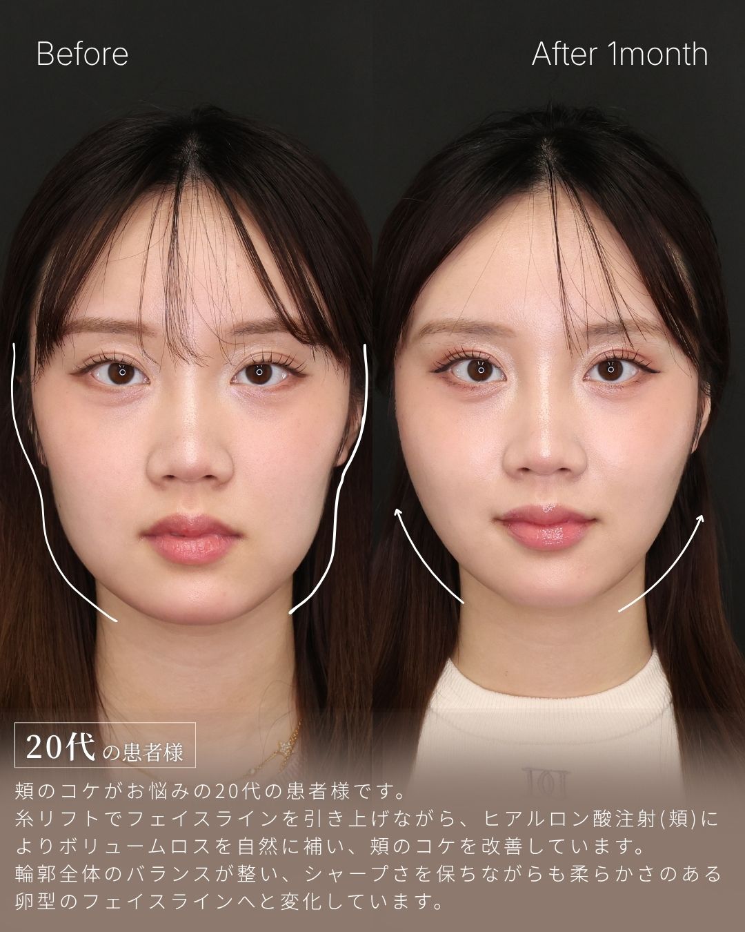 TAC式 ツヤ肌コラーゲンリフト®の症例写真 施術前後 
