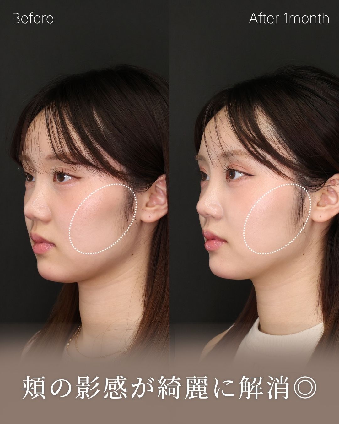 TAC式 ツヤ肌コラーゲンリフト®の症例写真 施術前後 