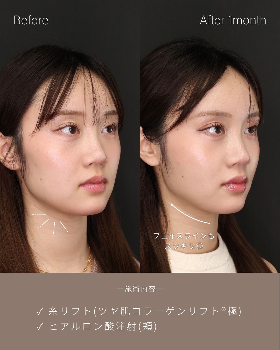 TAC式 ツヤ肌コラーゲンリフト®の症例写真 施術前後 