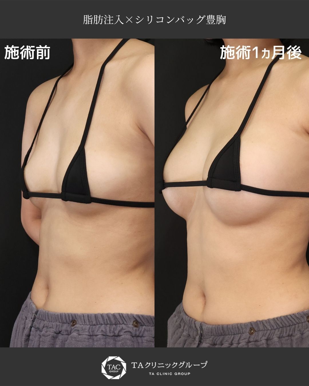 【ハイブリッド豊胸】“自然な仕上がり”を叶えた1ヶ月後の症例｜脂肪注入×シリコンバッグ