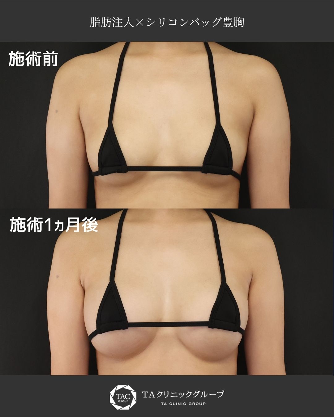 シリコンバッグ豊胸（人工乳腺バッグ）/脂肪注入豊胸（コンデンスリッチ・ピュアグラフト・１day脂肪豊胸）の症例写真 施術前後 
