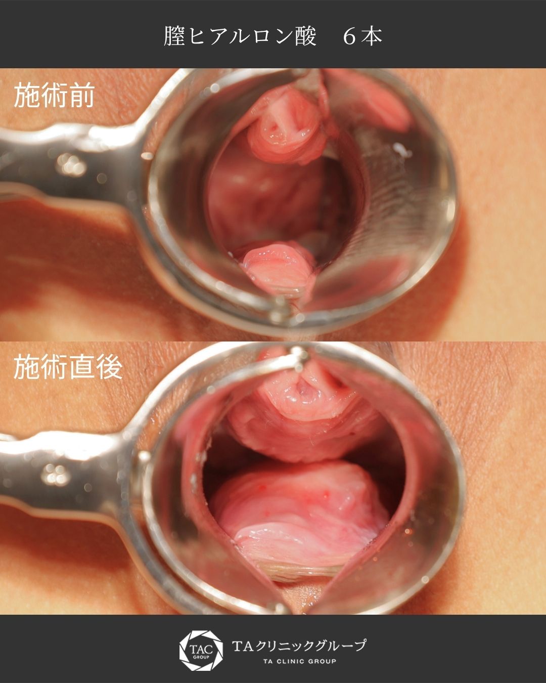【膣ヒアルロン酸】ちなら・尿漏れを改善｜快適な毎日へ