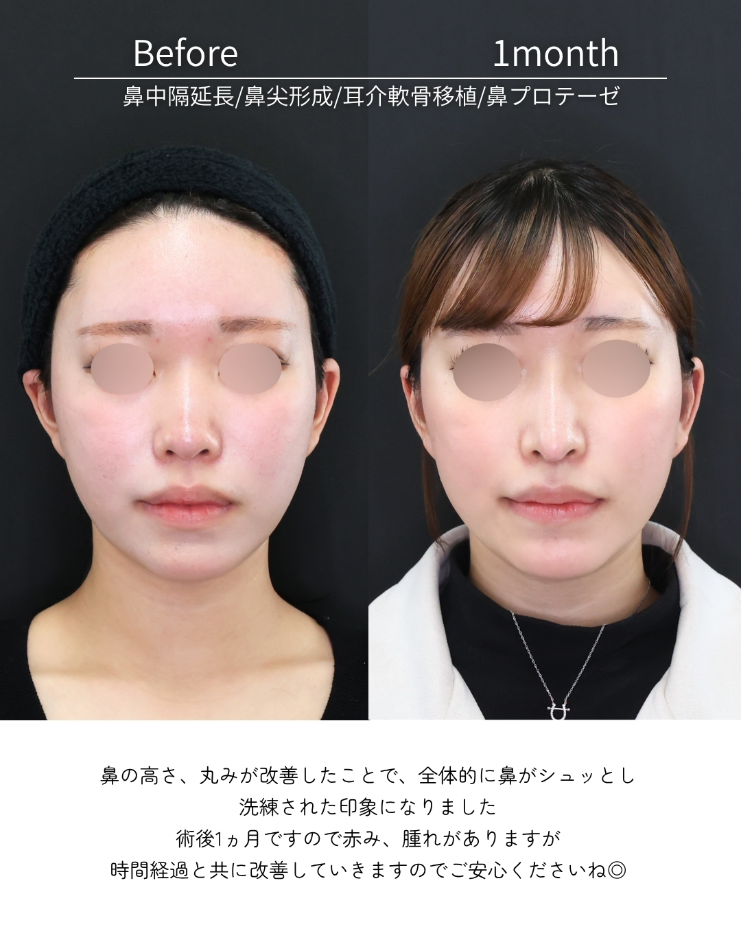 鼻中隔延長術/鼻尖形成・鼻尖縮小/鼻先軟骨移植の症例写真 施術前後 