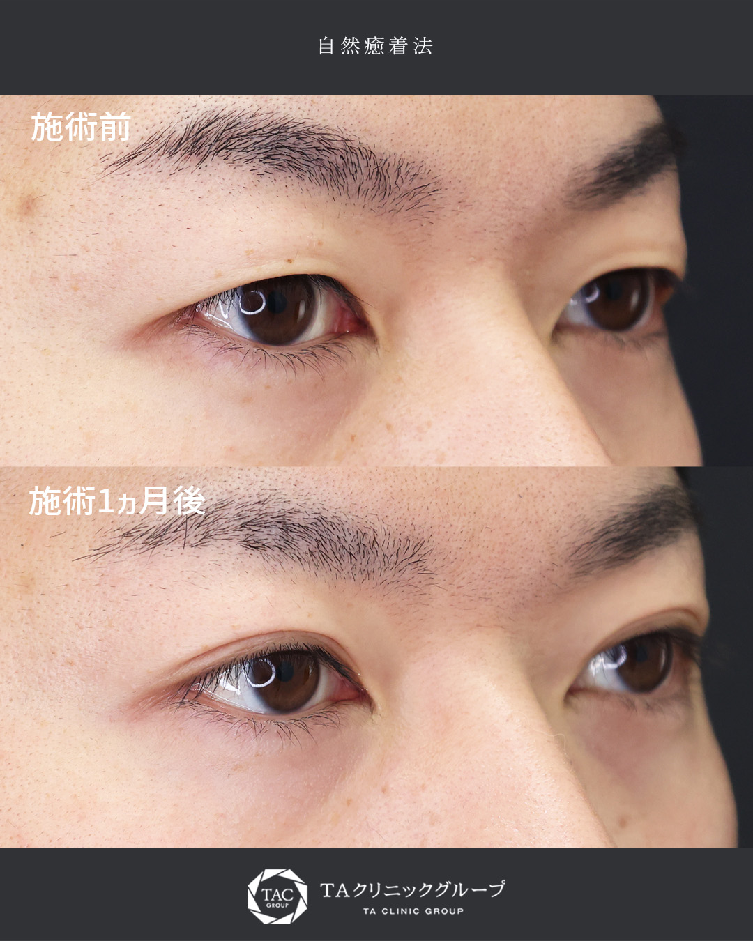 自然癒着法の症例写真 施術前後 
