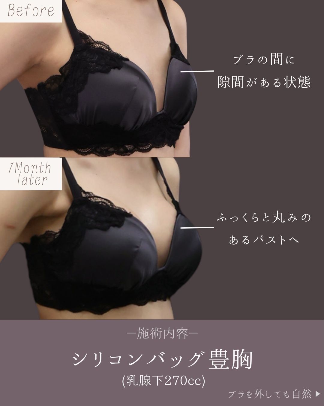 シリコンバッグ豊胸（人工乳腺バッグ）の症例写真 施術前後 