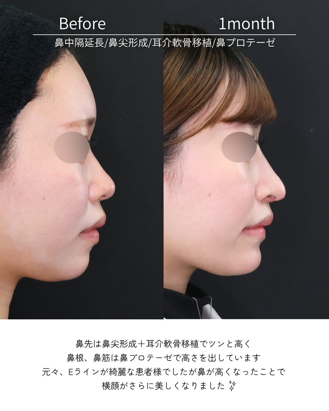 鼻中隔延長術/鼻尖形成・鼻尖縮小/鼻先軟骨移植の症例写真 施術前後 