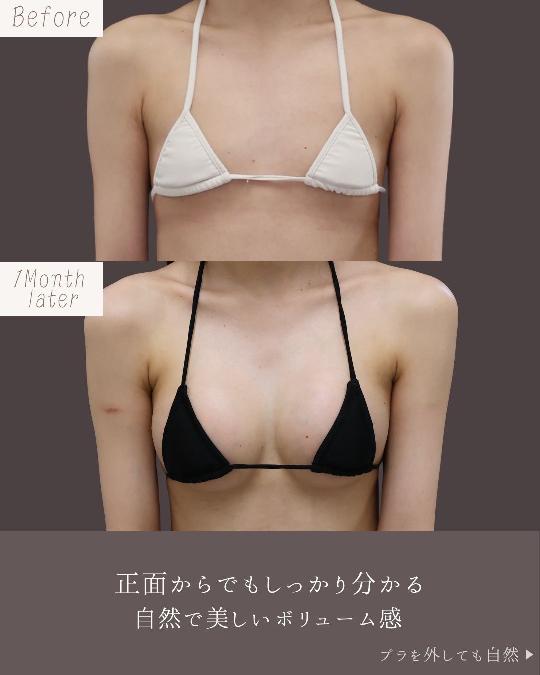 シリコンバッグ豊胸（人工乳腺バッグ）の症例写真 施術前後 