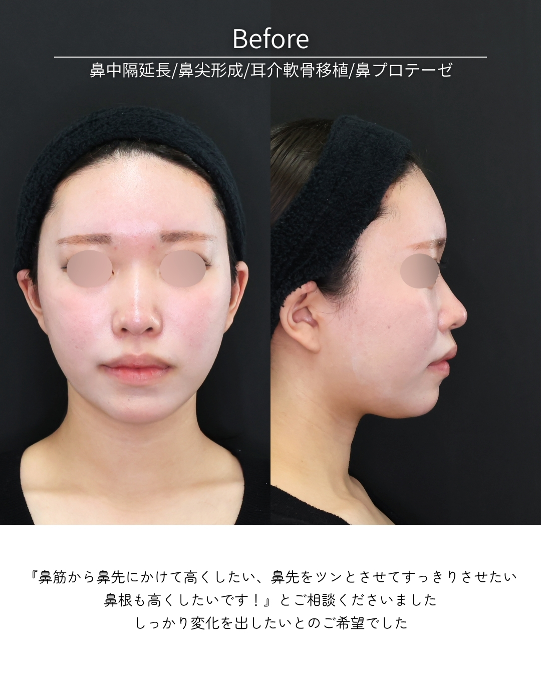 鼻中隔延長術/鼻尖形成・鼻尖縮小/鼻先軟骨移植の症例写真 施術前後 