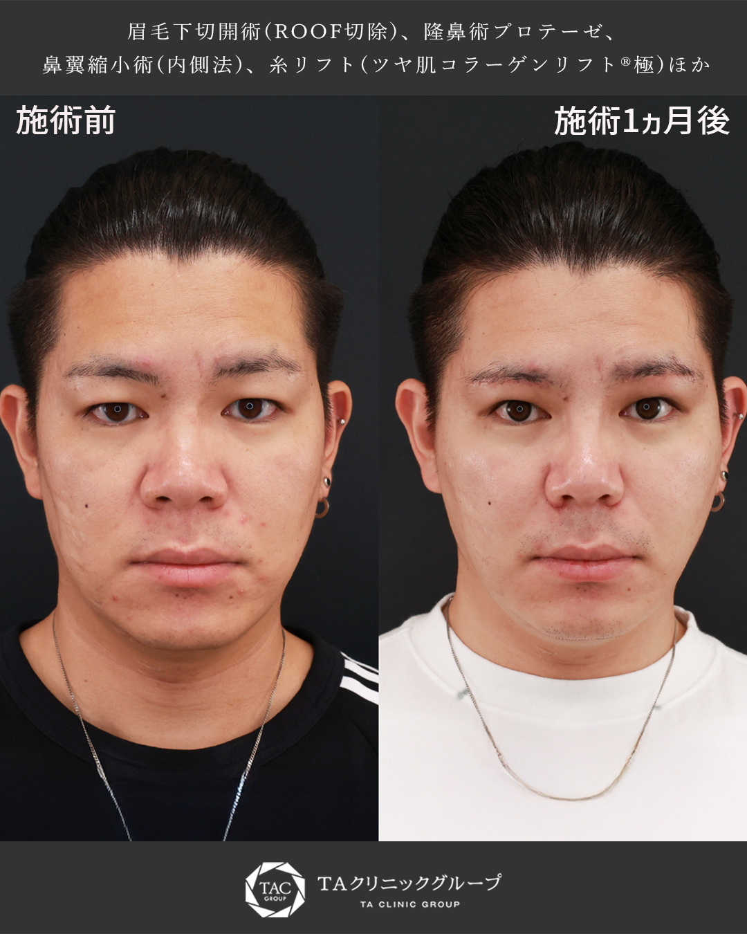 眉毛下切開術/隆鼻術（プロテーゼ・自家組織）/TAC式 鼻翼縮小術（小鼻縮小）の症例写真 施術前後 