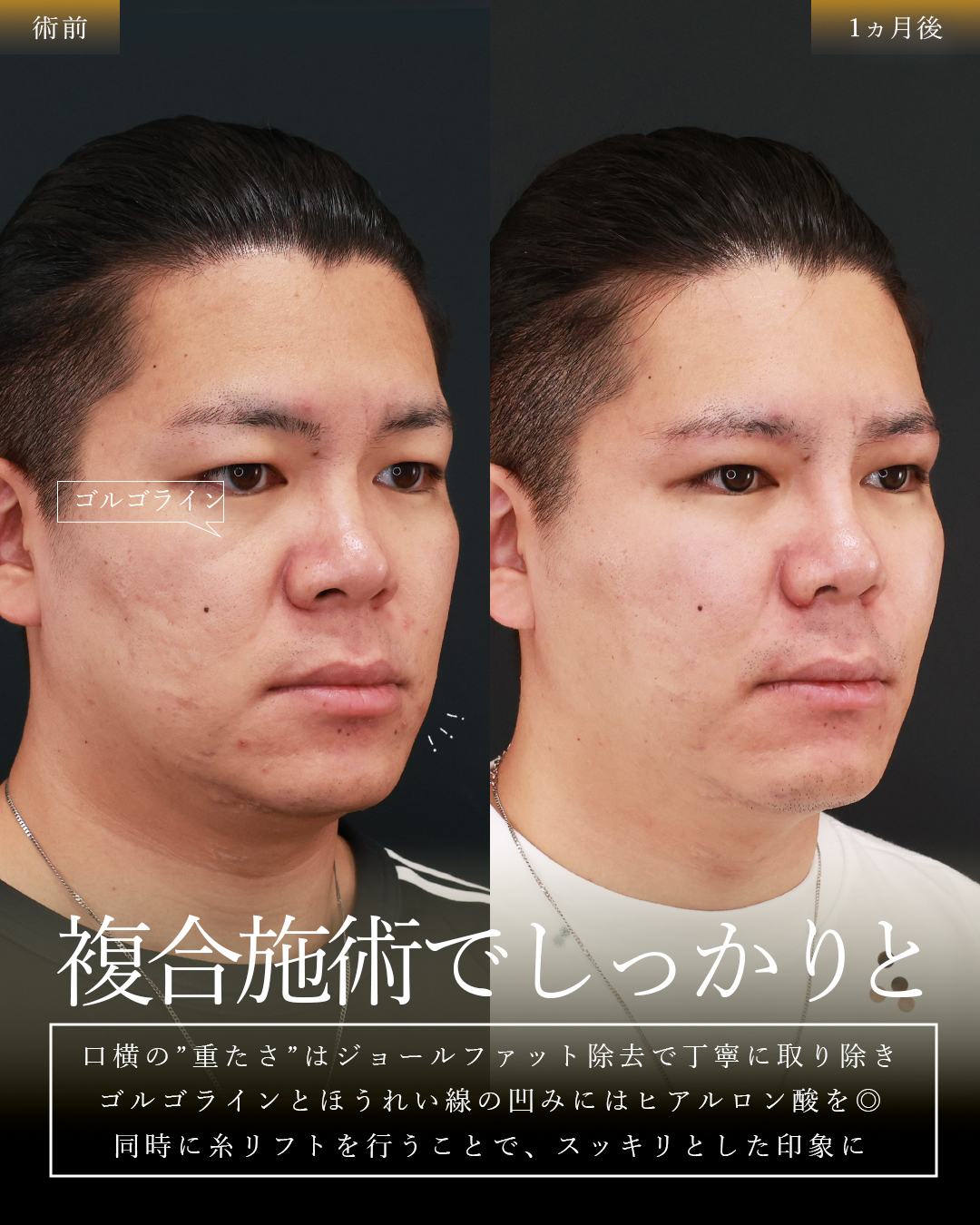眉毛下切開術/隆鼻術（プロテーゼ・自家組織）/TAC式 鼻翼縮小術（小鼻縮小）の症例写真 施術前後 