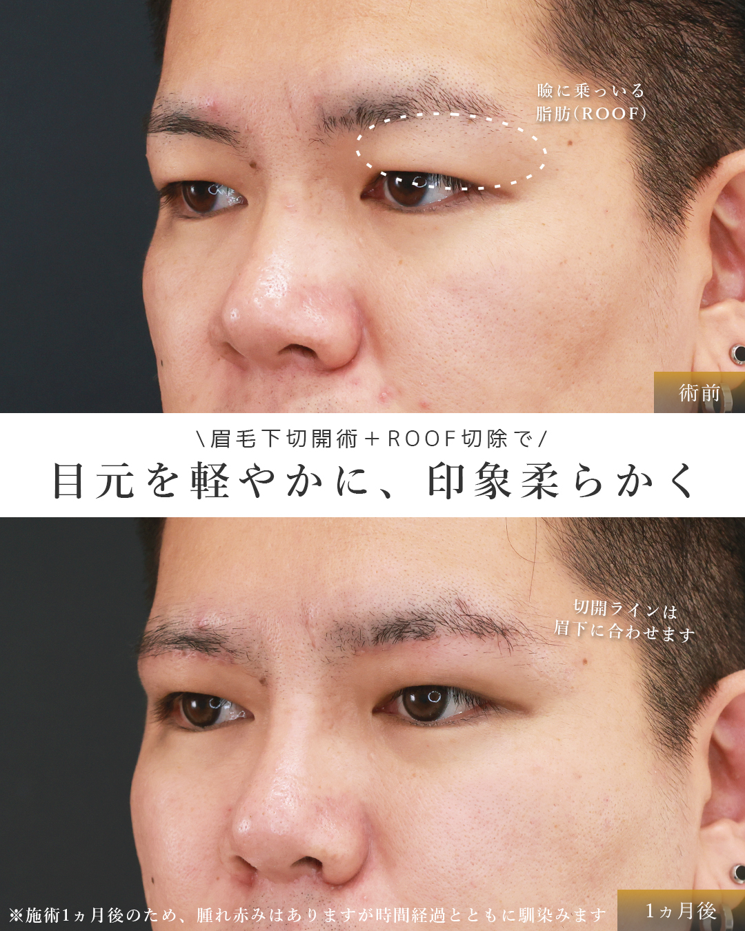 眉毛下切開術/隆鼻術（プロテーゼ・自家組織）/TAC式 鼻翼縮小術（小鼻縮小）の症例写真 施術前後 