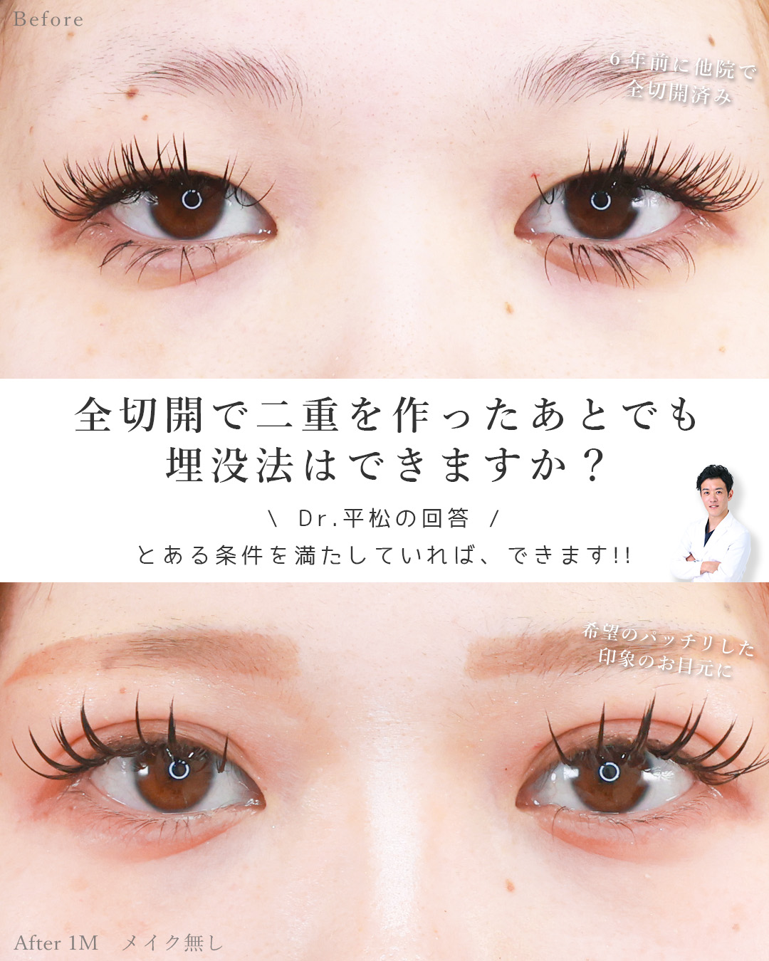 二重埋没法の症例写真 施術前後 