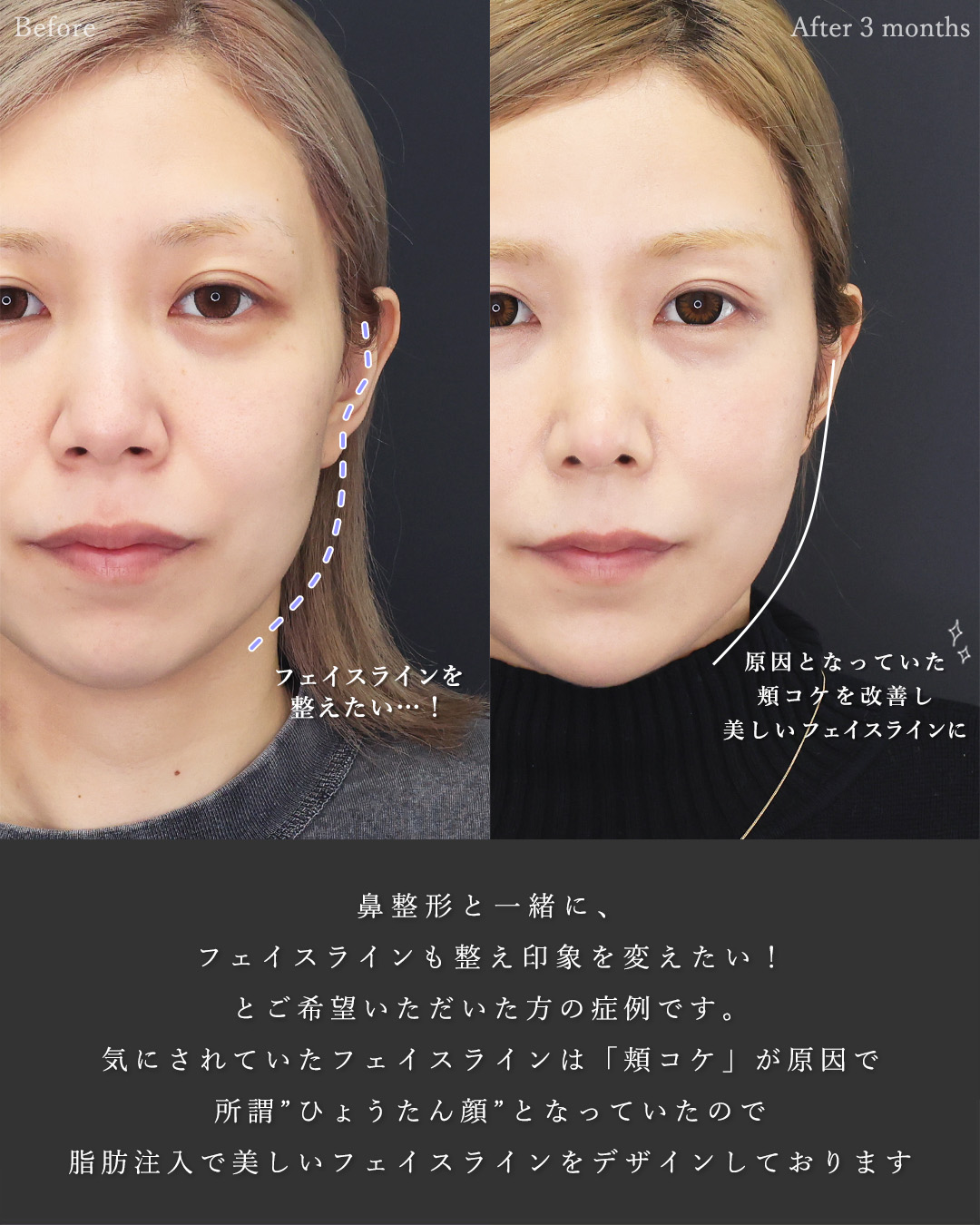 顔の脂肪注入(コンデンスリッチフェイス)/おでこの脂肪注入（オルチャンデコ形成）/鼻中隔延長術の症例写真 施術前後 