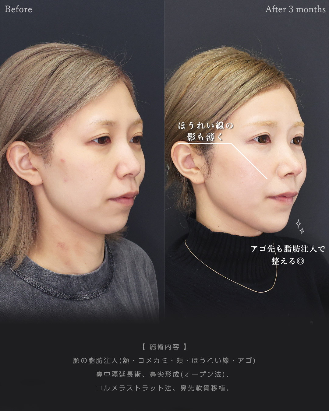 顔の脂肪注入(コンデンスリッチフェイス)/おでこの脂肪注入（オルチャンデコ形成）/鼻中隔延長術の症例写真 施術前後 