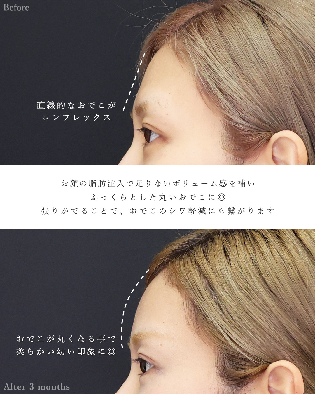 顔の脂肪注入(コンデンスリッチフェイス)/おでこの脂肪注入（オルチャンデコ形成）/鼻中隔延長術の症例写真 施術前後 