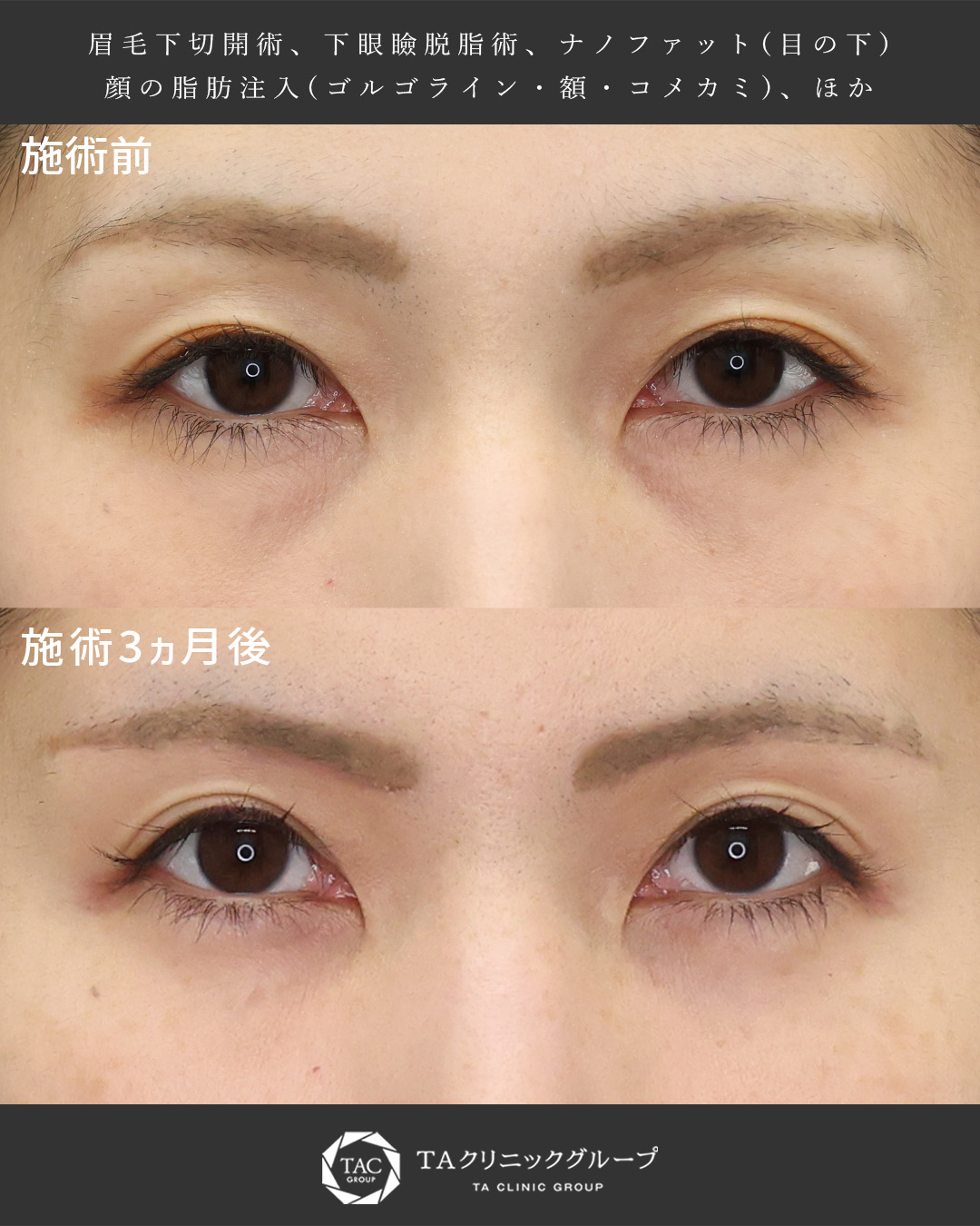 40代｜目元のエイジングケアで若々しい印象へ【眉下リフト/クマ取り】