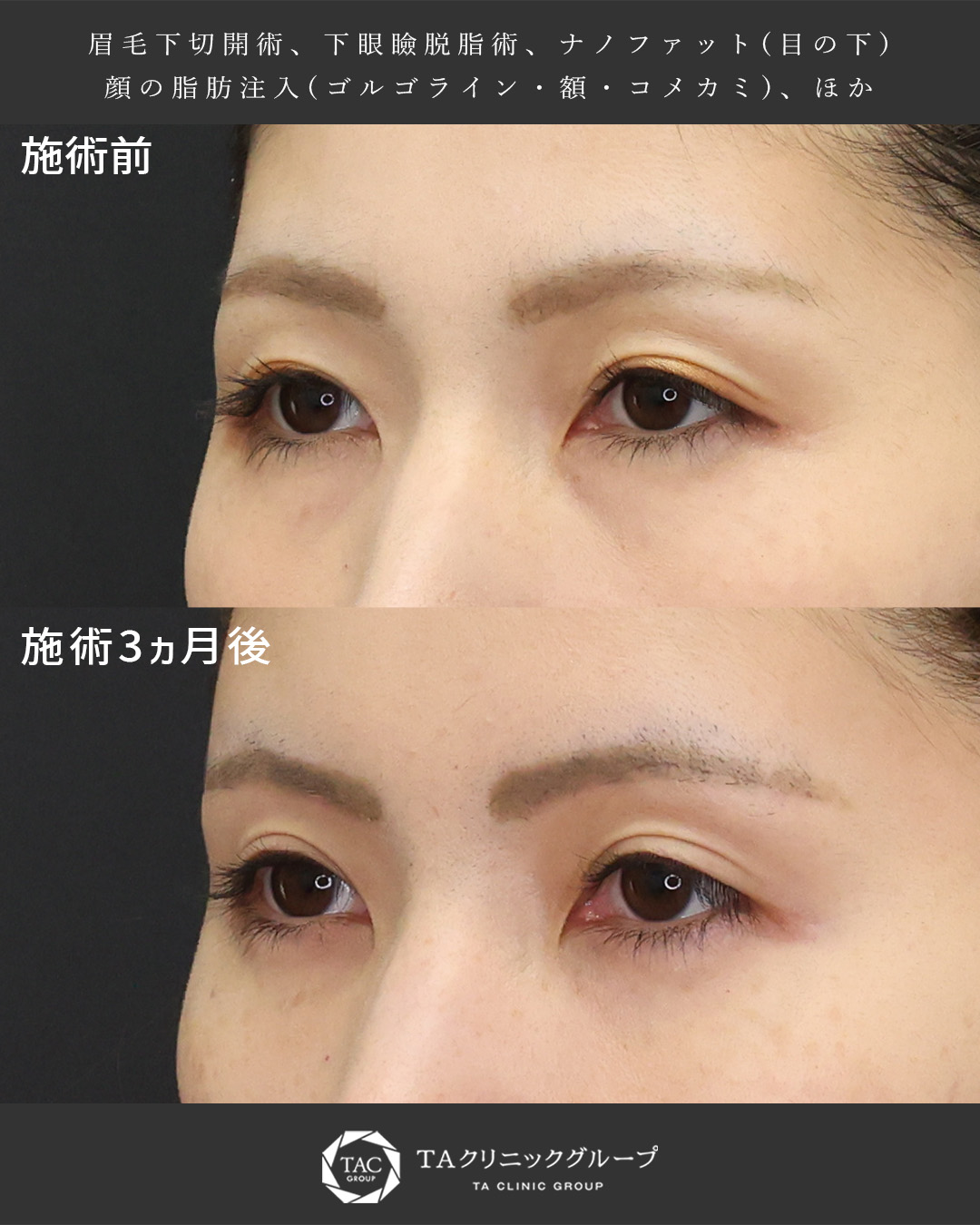 眉毛下切開術/下眼瞼脱脂術（目の下のたるみ取り・目の下の脂肪ふくらみ取り）/おでこの脂肪注入（オルチャンデコ形成）の症例写真 施術前後 