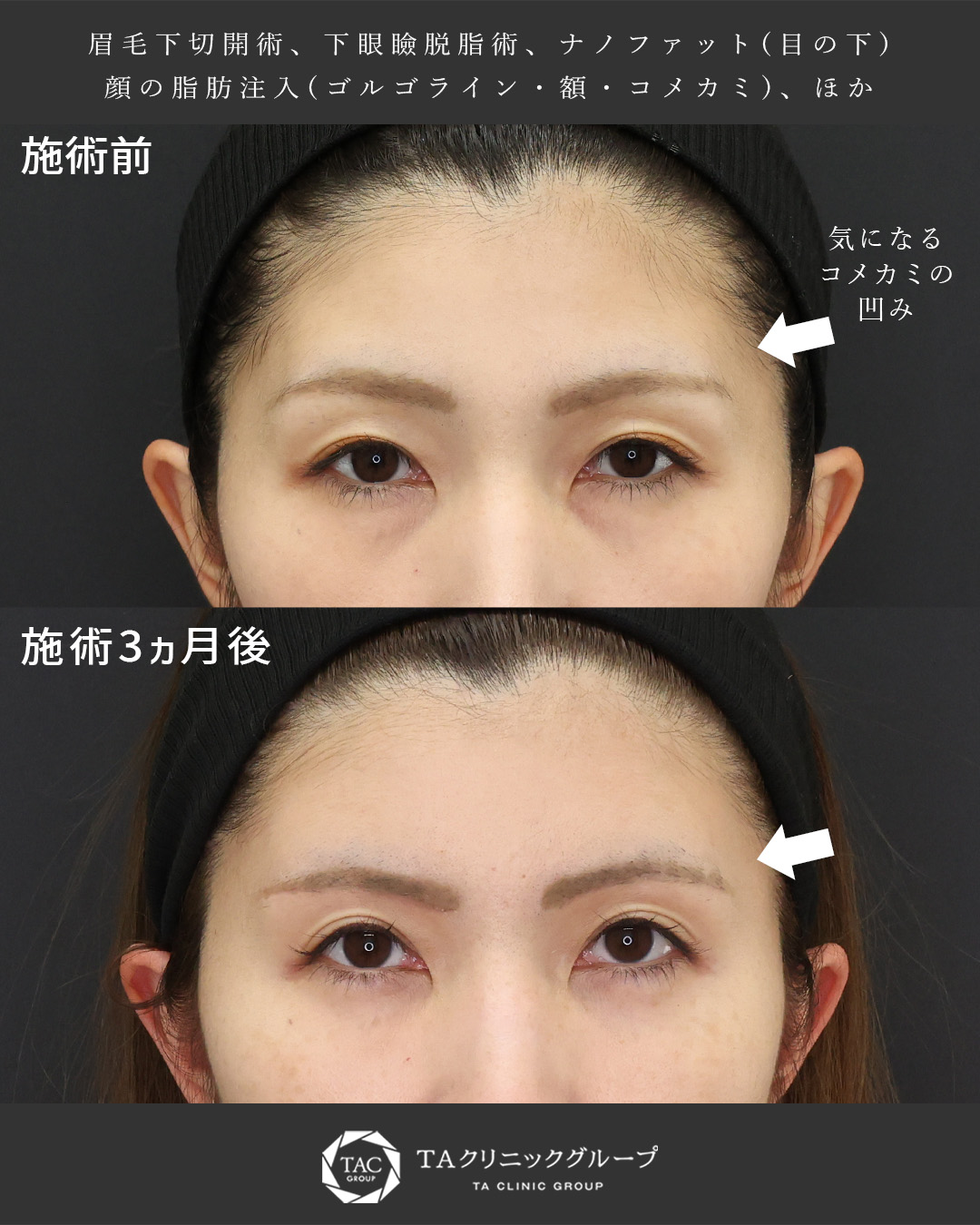 眉毛下切開術/下眼瞼脱脂術（目の下のたるみ取り・目の下の脂肪ふくらみ取り）/おでこの脂肪注入（オルチャンデコ形成）の症例写真 施術前後 