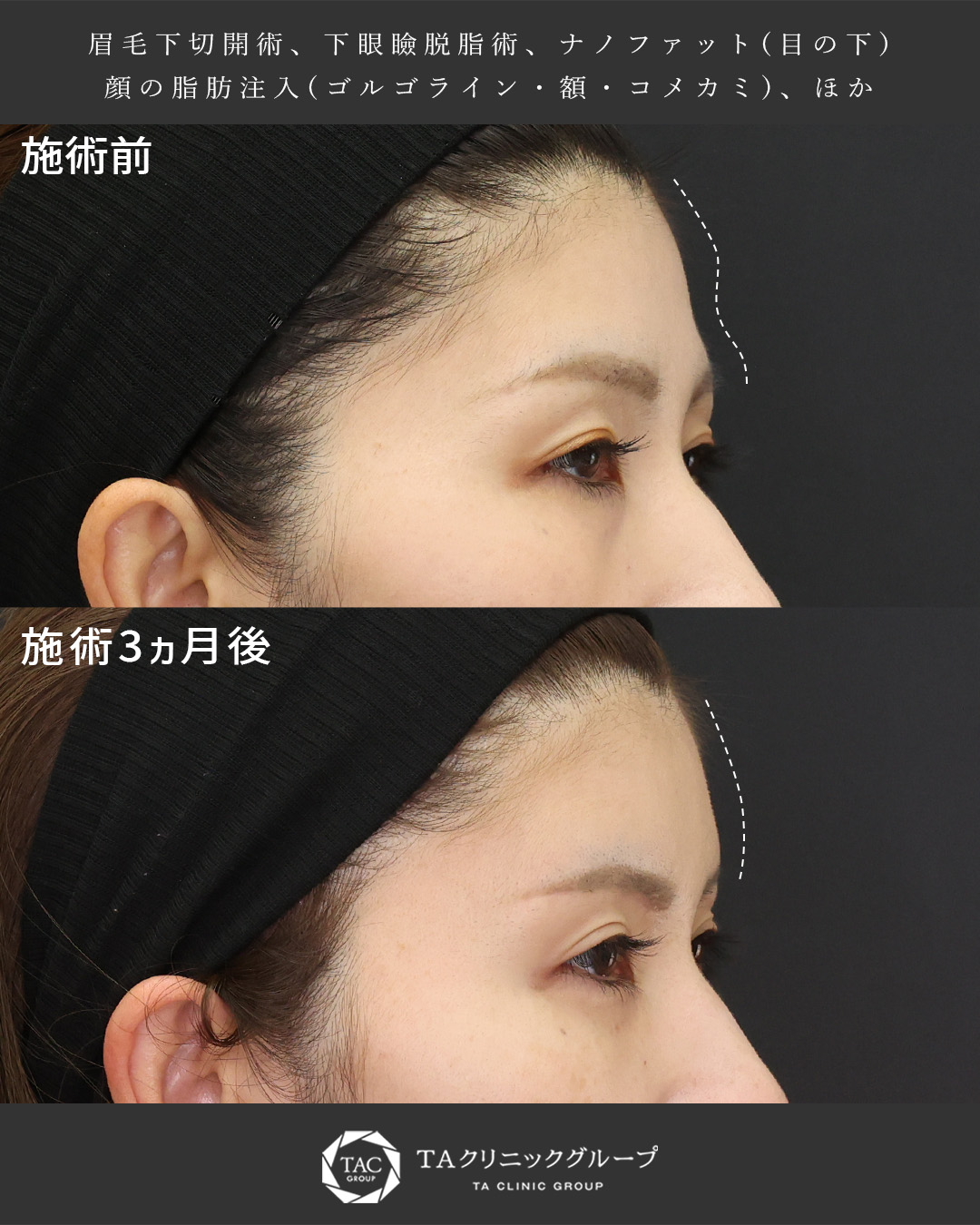 眉毛下切開術/下眼瞼脱脂術（目の下のたるみ取り・目の下の脂肪ふくらみ取り）/おでこの脂肪注入（オルチャンデコ形成）の症例写真 施術前後 
