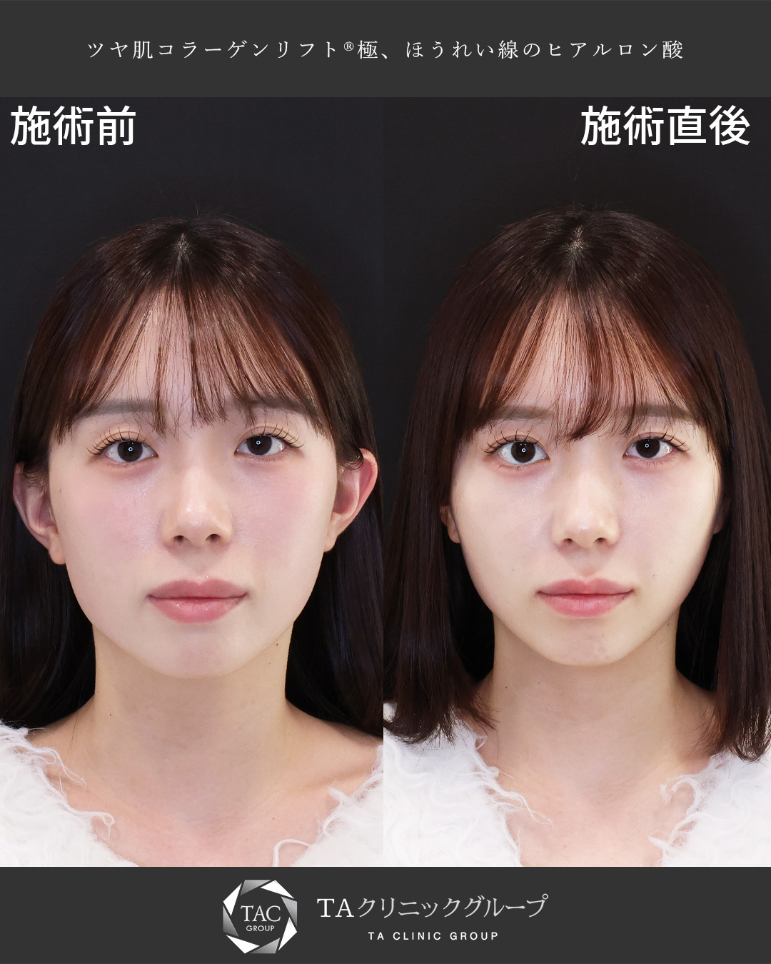 施術直後からこの変化！Dr.もりもりの腫れにくい糸リフト
