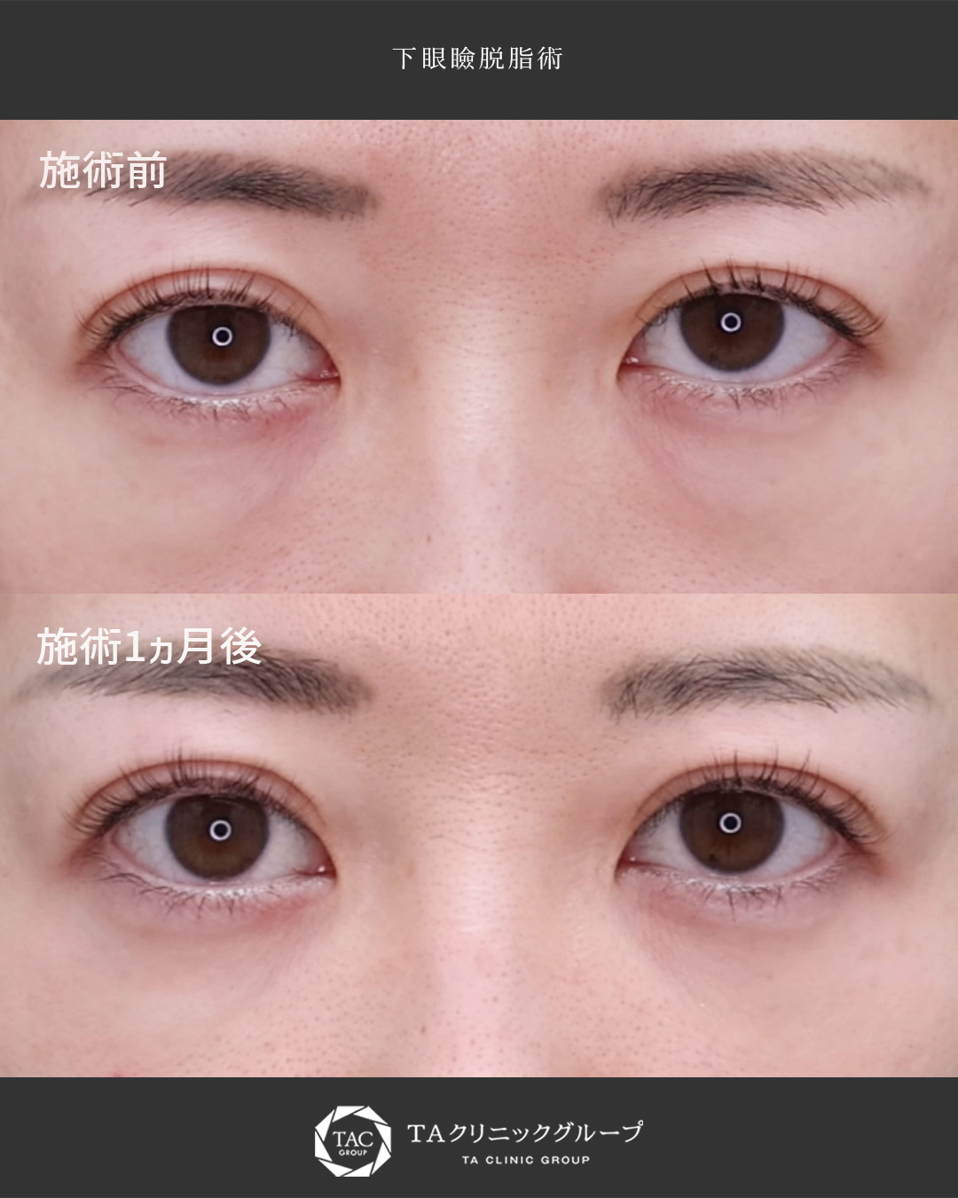 疲れ見え、老け見えにお悩みならご相談ください【クマ取り】