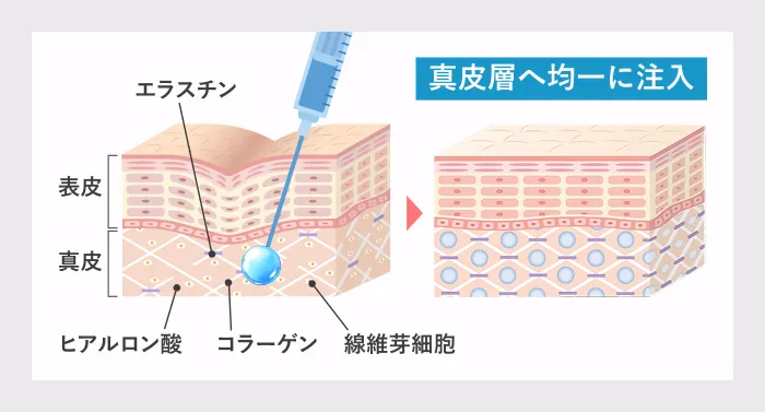 スキンバイブの作用機序｜ヒアルロン酸を真皮層へ均一に注入し保水環境を整えるイメージ図