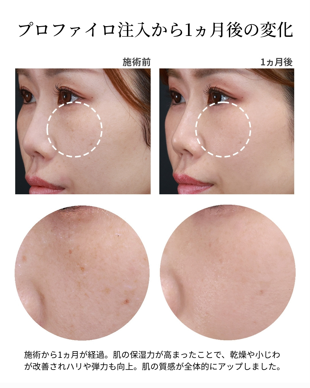 プロファイロの症例写真 施術前後 