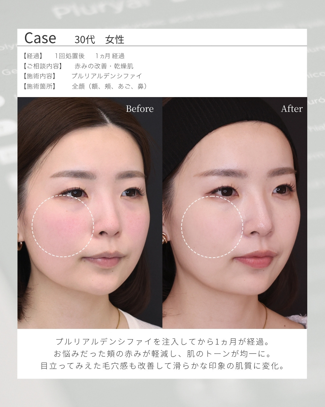 プルリアルデンシファイの症例写真 施術前後 