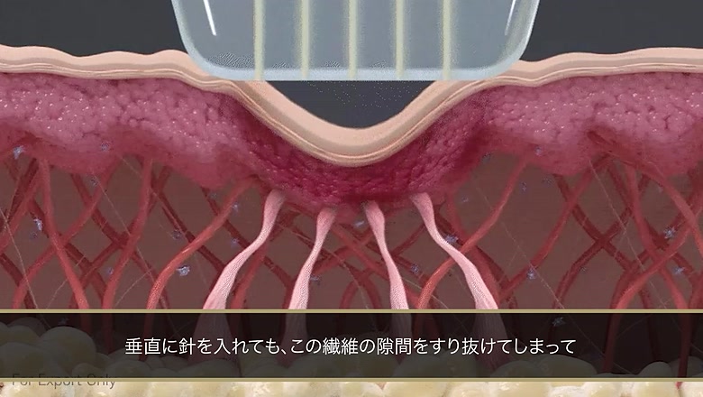 クレーターの原因となる癒着を示す図解