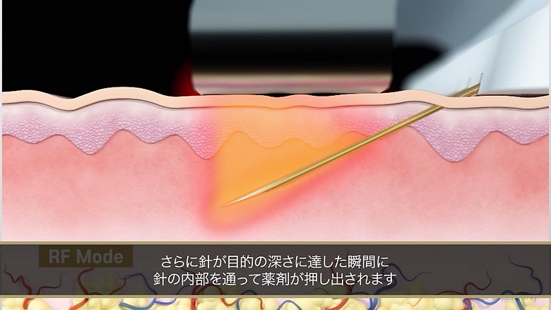 ブレッシングの薬剤導入イメージ
