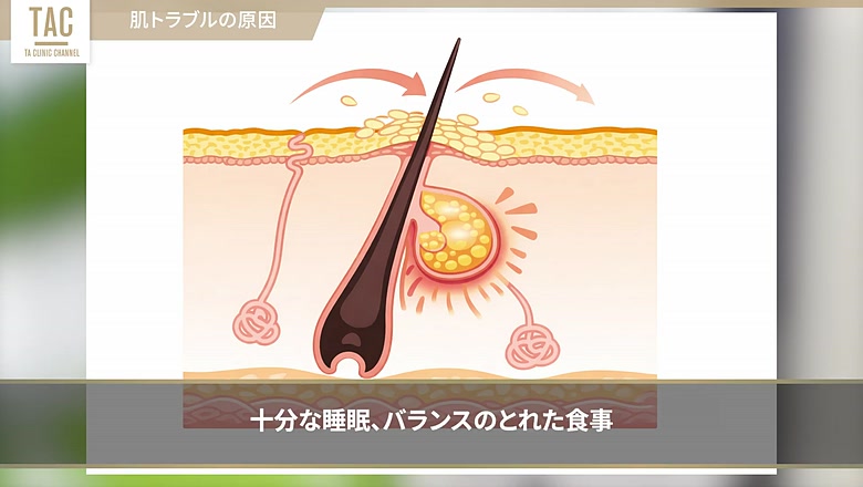 毛穴と皮脂の詰まりを示す肌構造の図解
