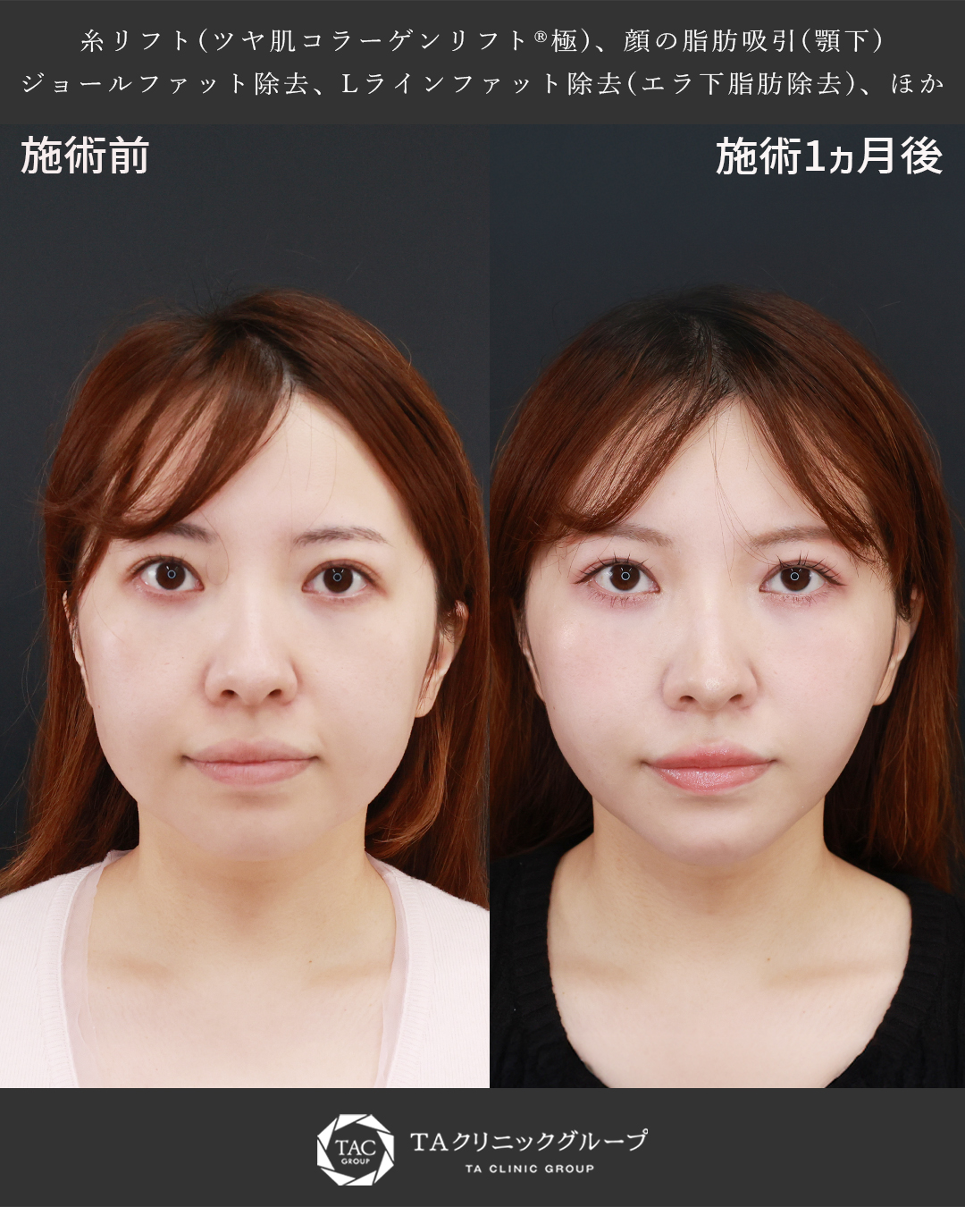 TAC式 ツヤ肌コラーゲンリフト®/顎下の脂肪吸引・顔の脂肪吸引/Lラインファット除去（エラ下脂肪除去）の症例写真 施術前後 
