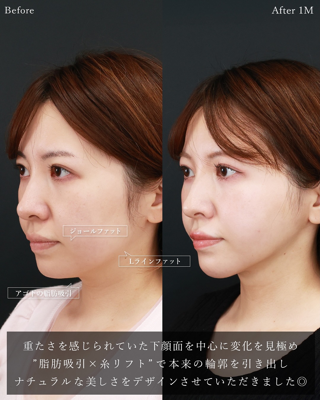 TAC式 ツヤ肌コラーゲンリフト®/顎下の脂肪吸引・顔の脂肪吸引/Lラインファット除去（エラ下脂肪除去）の症例写真 施術前後 