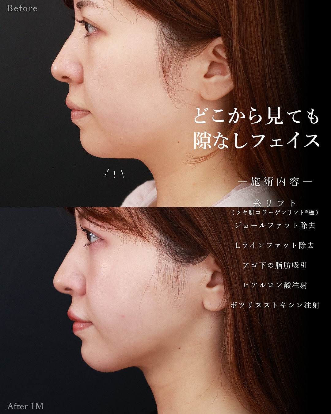 TAC式 ツヤ肌コラーゲンリフト®/顎下の脂肪吸引・顔の脂肪吸引/Lラインファット除去（エラ下脂肪除去）の症例写真 施術前後 