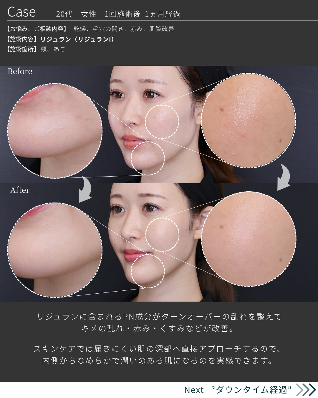 プルリアルデンシファイ/スキンバイブ（SKINVIVE）/プロファイロの症例写真 施術前後 