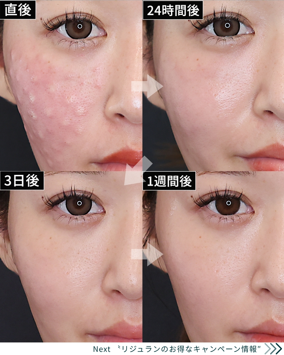 プルリアルデンシファイ/スキンバイブ（SKINVIVE）/プロファイロの症例写真 施術前後 